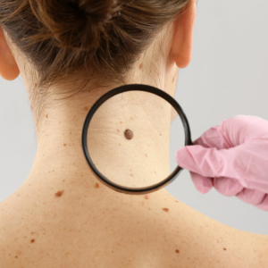 Правда ли травма родинки приводит к раку: новые данные